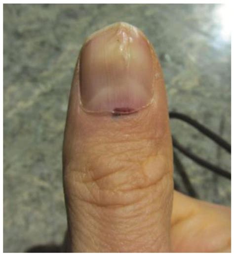 pictures of melanoma in fingernail bed